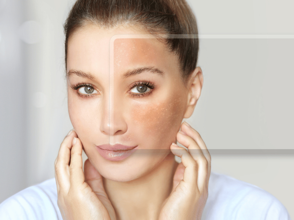 mudanças no corpo e pele na gravidez: melasma na gravidez manchas no rosto